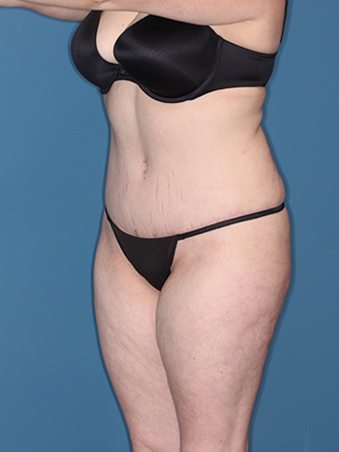 Case--37146 | After Liposuction 3