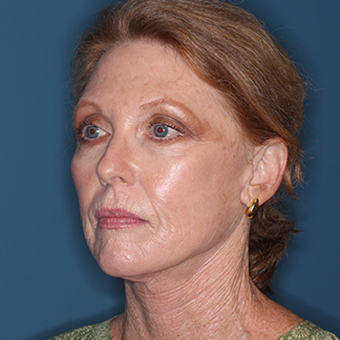 Case--36727 | After Facelift and Neck Lift 3