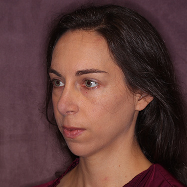 Case--36005 | After Nose Surgery (Rhinoplasty) 4
