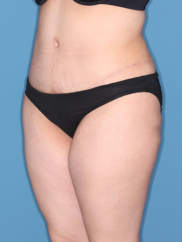 Case--37542 | After Liposuction 3
