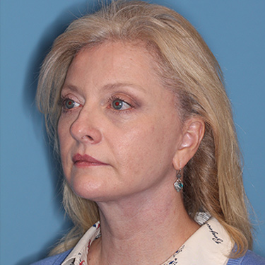 Case--36776 | After Brow Lift 3