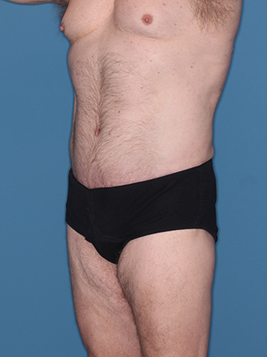 Case--36843 | After Liposuction for Men 2