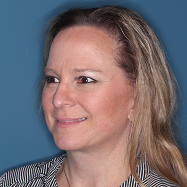 Case--36591 | After Facelift and Neck Lift 3