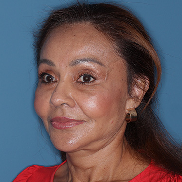 Case--38938 | After Eyelid Surgery (Blepharoplasty) 3