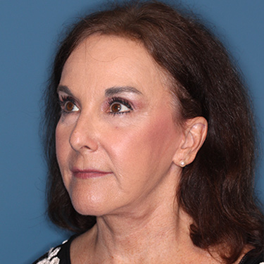 Case--38087 | After Brow Lift 3