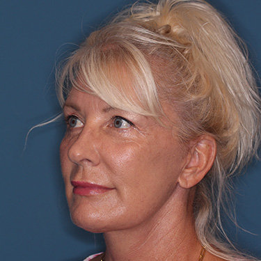 Case--40232 | After Facelift and Neck Lift 3