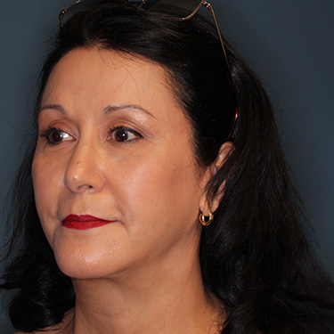 Case--40089 | After Eyelid Surgery (Blepharoplasty) 3