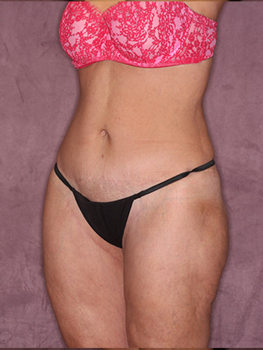 Case--39670 | After Thigh Lift 3