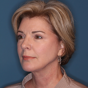 Case--38239 | After Eyelid Surgery (Blepharoplasty) 3