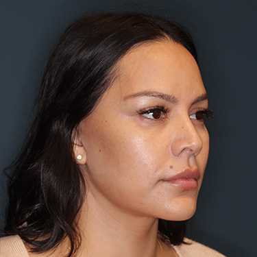 Case--42025 | After Facelift and Neck Lift 2