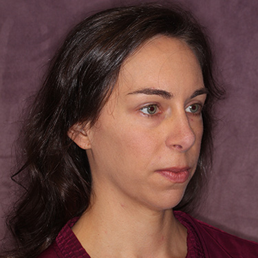 Case--36005 | After Nose Surgery (Rhinoplasty) 2