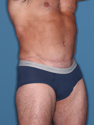 Case--36808 | After True Form Tummy Tuck® for Men 2
