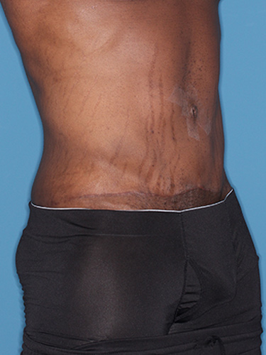 Case--36791 | After Body Lift for Men 2