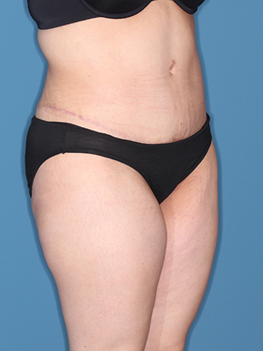 Case--37542 | After Liposuction 2