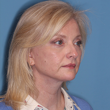Case--36776 | After Brow Lift 2