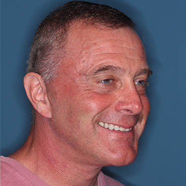 Case--41459 | After Facelift and Neck Lift for Men 2