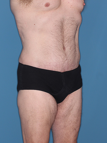 Case--36843 | After Liposuction for Men 3