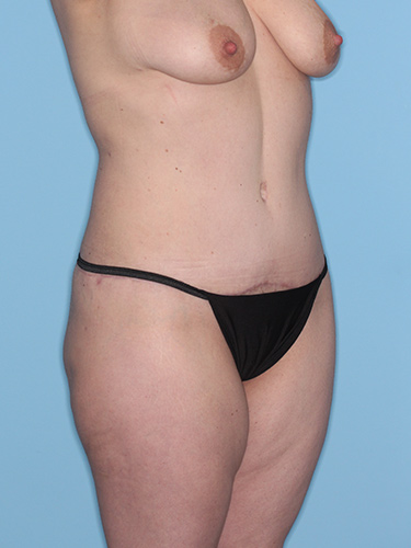 Case--37797 | After Fat Transfer to Buttocks 2