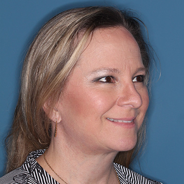 Case--36591 | After Facelift and Neck Lift 2