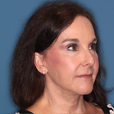 Case--38087 | After Brow Lift 2