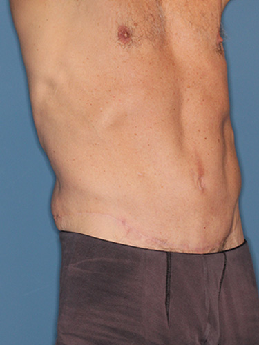 Case--40026 | After True Form Tummy Tuck® for Men 2