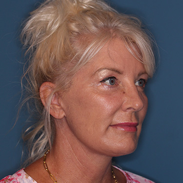 Case--40232 | After Facelift and Neck Lift 2