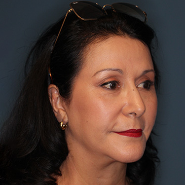 Case--40089 | After Eyelid Surgery (Blepharoplasty) 2