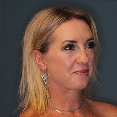 Case--43126 | After Eyelid Surgery (Blepharoplasty) 2