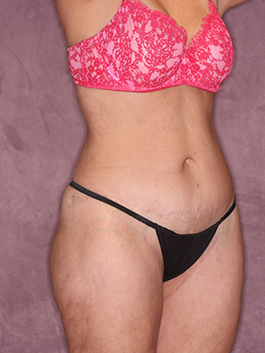 Case--39670 | After Thigh Lift 2