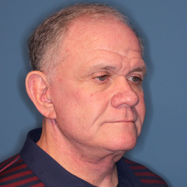 Case--40393 | After Facelift and Neck Lift for Men 2