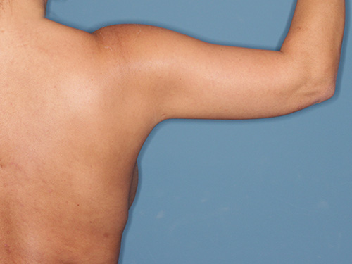 Case--40562 | After Arm Lift 3