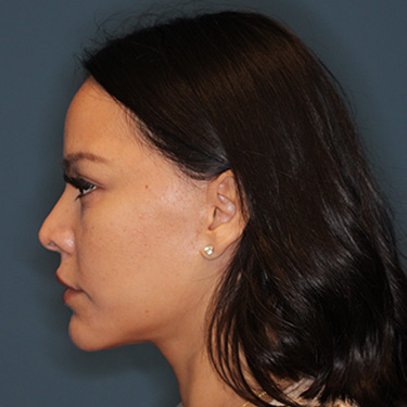 Case--42025 | After Facelift and Neck Lift 5