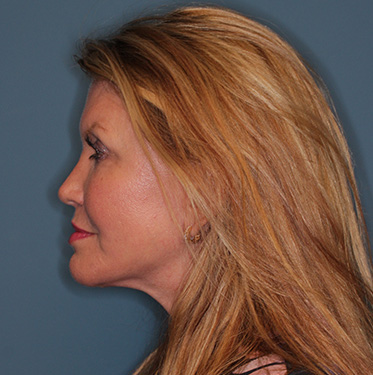 Case--41496 | After Eyelid Surgery (Blepharoplasty) 5