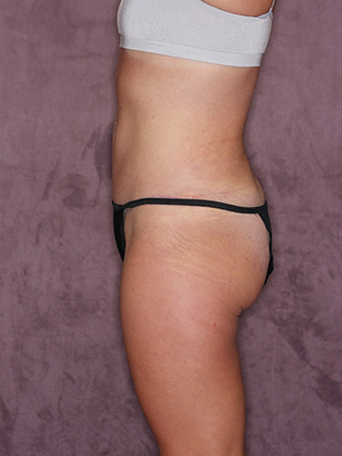 Case--39748 | After Liposuction 5