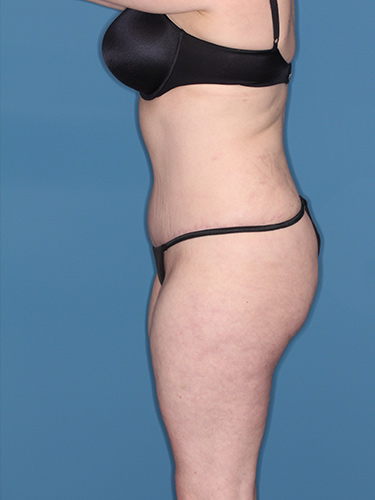 Case--37146 | After Liposuction 5