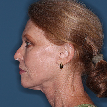 Case--36727 | After Facelift and Neck Lift 5