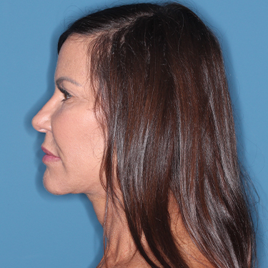 Case--37967 | After Facelift and Neck Lift 5