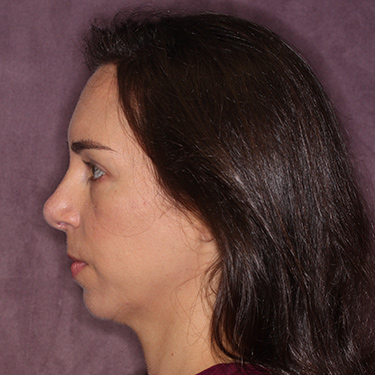 Case--36005 | After Nose Surgery (Rhinoplasty) 5