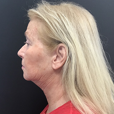 Case--39696 | After Eyelid Surgery (Blepharoplasty) 5
