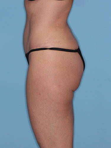 Case--39580 | After Liposuction 5