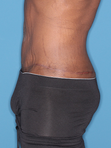 Case--36791 | After Body Lift for Men 5