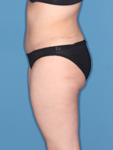 Case--37542 | After Liposuction 5