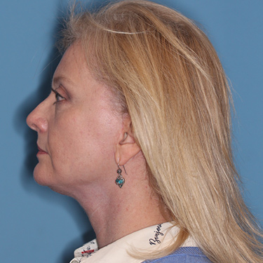 Case--36776 | After Brow Lift 5