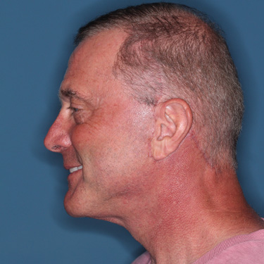 Case--41459 | After Facelift and Neck Lift for Men 5