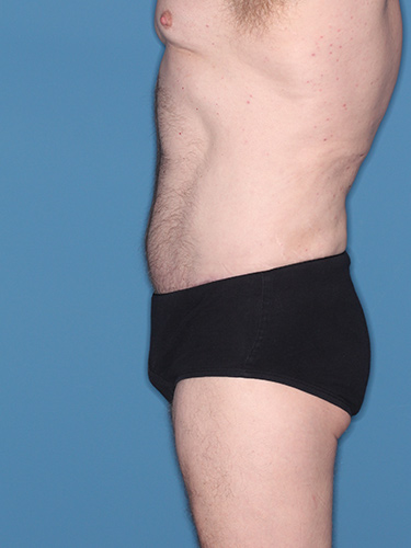 Case--36843 | After Liposuction for Men 4
