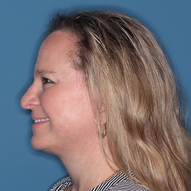 Case--36591 | After Facelift and Neck Lift 5