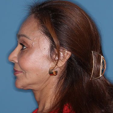 Case--38938 | After Eyelid Surgery (Blepharoplasty) 5