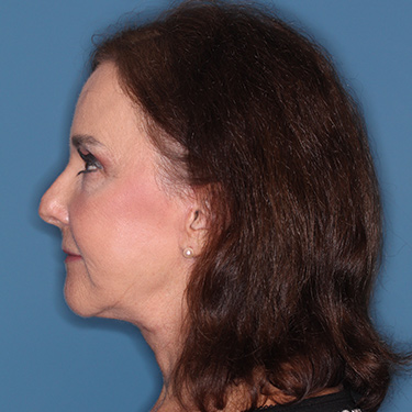 Case--38087 | After Brow Lift 5