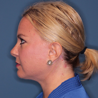 Case--39150 | After Eyelid Surgery (Blepharoplasty) 5
