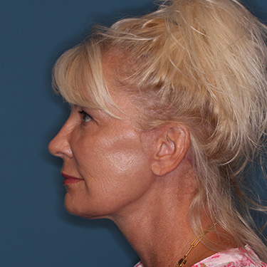 Case--40232 | After Facelift and Neck Lift 5